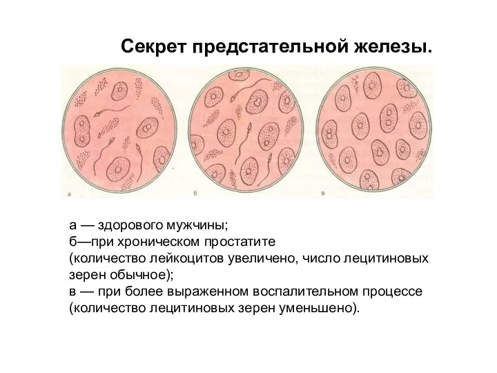 Секрет предстательной железы. а — здорового мужчины; б—при хроническом простатите