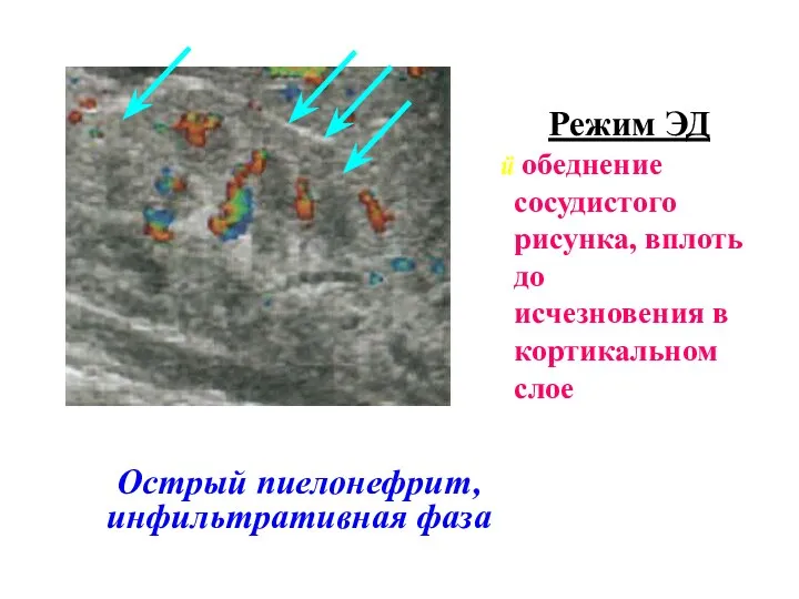 Острый пиелонефрит, инфильтративная фаза Режим ЭД обеднение сосудистого рисунка, вплоть до исчезновения в кортикальном слое