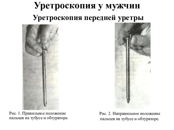Уретроскопия у мужчин Уретроскопия передней уретры Рис. 2. Неправильное положение