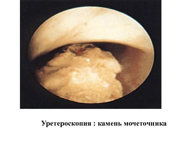 Уретероскопия : камень мочеточника