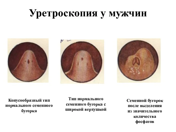 Уретроскопия у мужчин Конусообразный тип нормального семенного бугорка Тип нормального семенного бугорка с