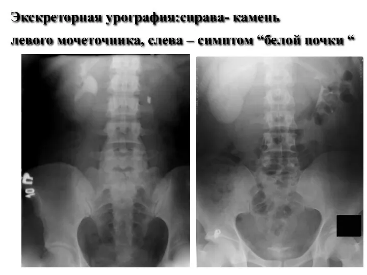 Экскреторная урография:справа- камень левого мочеточника, слева – симптом “белой почки “