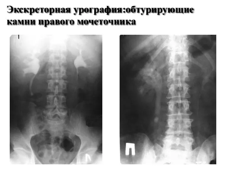 Экскреторная урография:обтурирующие камни правого мочеточника