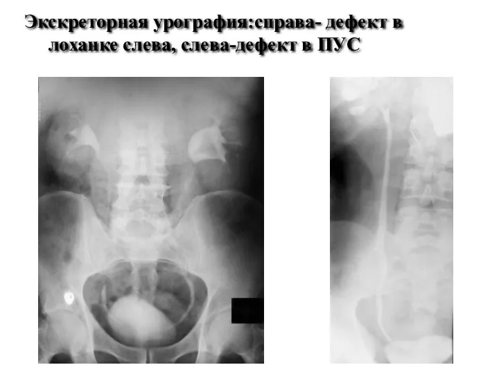 Экскреторная урография:справа- дефект в лоханке слева, слева-дефект в ПУС