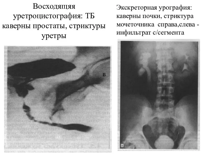 Экскреторная урография: каверны почки, стриктура мочеточника справа,слева - инфильтрат с/сегмента в Восходящяя уретроцистография: