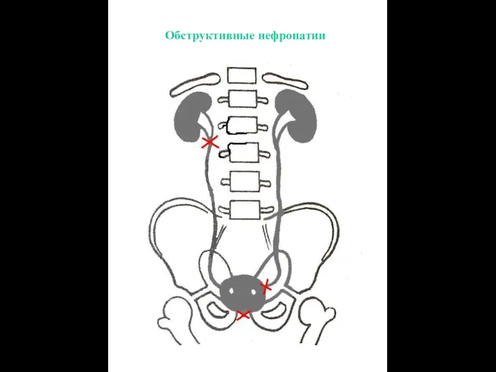 Обструктивные нефропатии