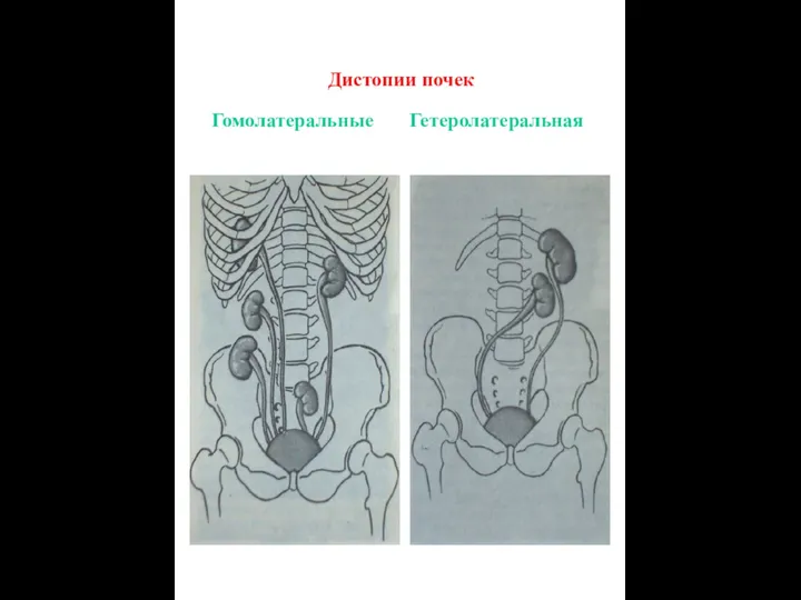 Гомолатеральные Гетеролатеральная Дистопии почек