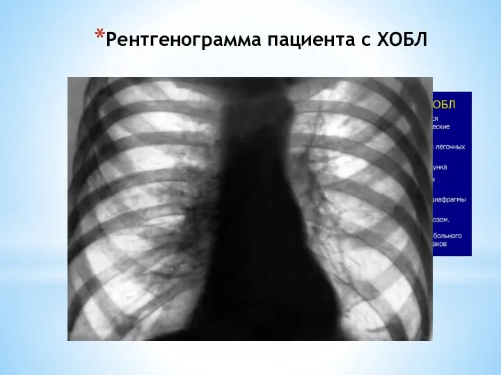 Рентгенограмма пациента с ХОБЛ