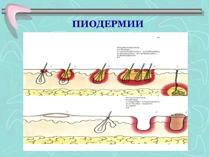 ПИОДЕРМИИ