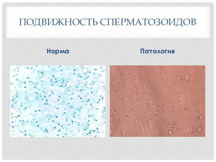 ПОДВИЖНОСТЬ СПЕРМАТОЗОИДОВ Норма Патология