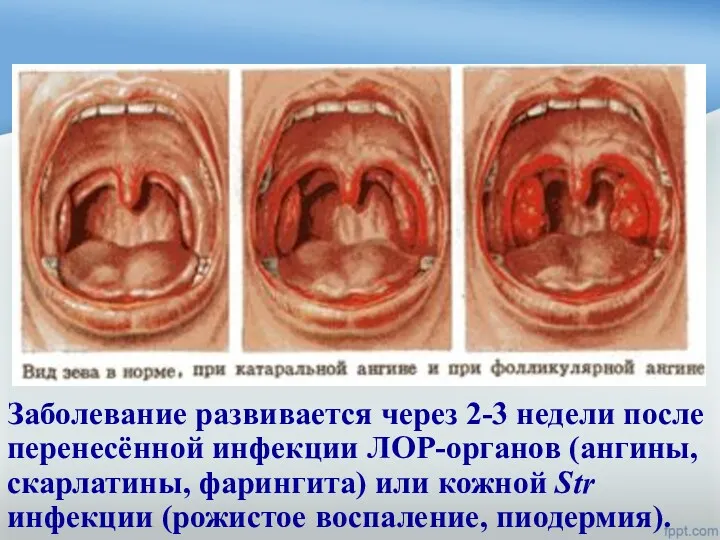 Заболевание развивается через 2-3 недели после перенесённой инфекции ЛОР-органов (ангины,