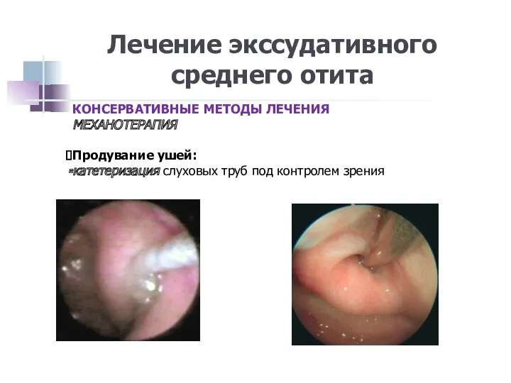 Лечение экссудативного среднего отита КОНСЕРВАТИВНЫЕ МЕТОДЫ ЛЕЧЕНИЯ МЕХАНОТЕРАПИЯ Продувание ушей: катетеризация слуховых труб под контролем зрения