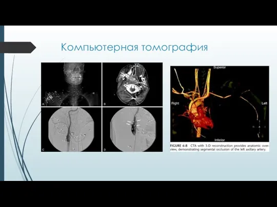 Компьютерная томография