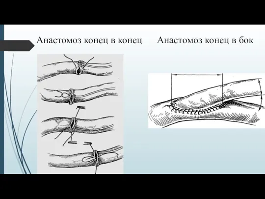 Анастомоз конец в конец Анастомоз конец в бок