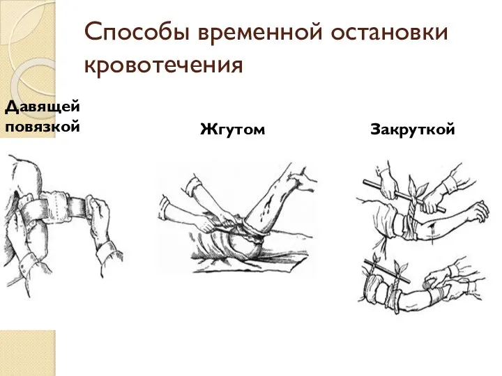 Способы временной остановки кровотечения Давящей повязкой Жгутом Закруткой