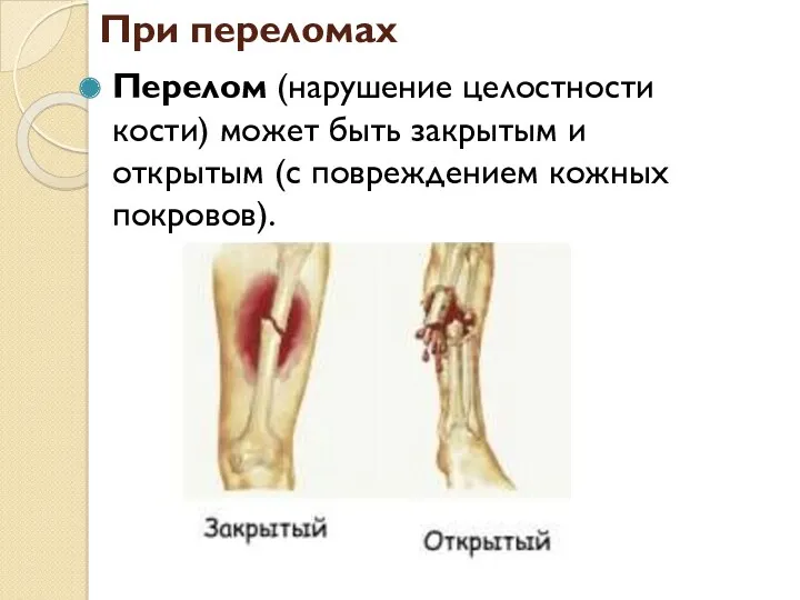 При переломах Перелом (нарушение целостности кости) может быть закрытым и открытым (с повреждением кожных покровов).
