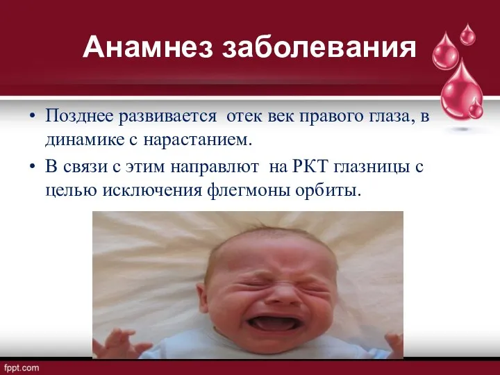 Анамнез заболевания Позднее развивается отек век правого глаза, в динамике с нарастанием. В