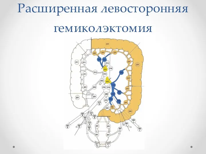 Расширенная левосторонняя гемиколэктомия