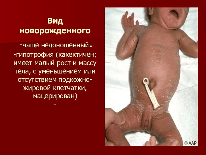 Вид новорожденного -чаще недоношенный. -гипотрофия (кахектичен; имеет малый рост и