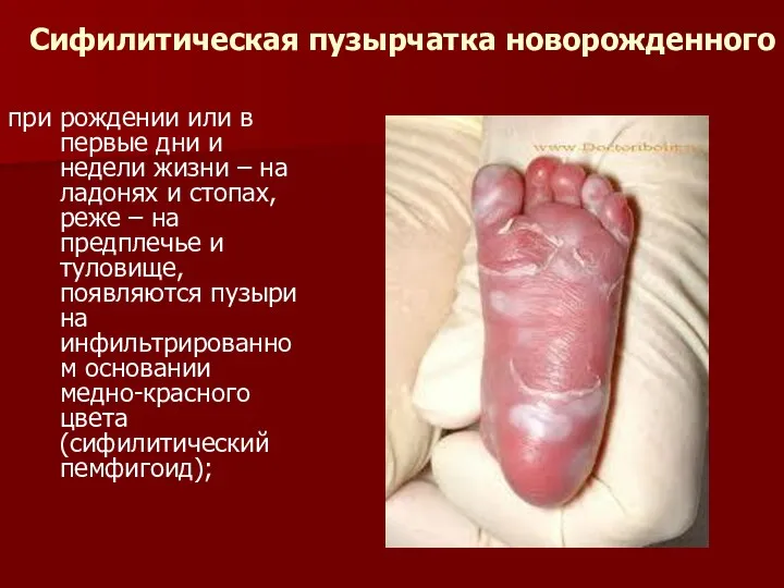 Сифилитическая пузырчатка новорожденного при рождении или в первые дни и