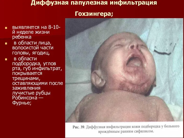 Диффузная папулезная инфильтрация Гохзингера; выявляется на 8-10-й неделе жизни ребенка