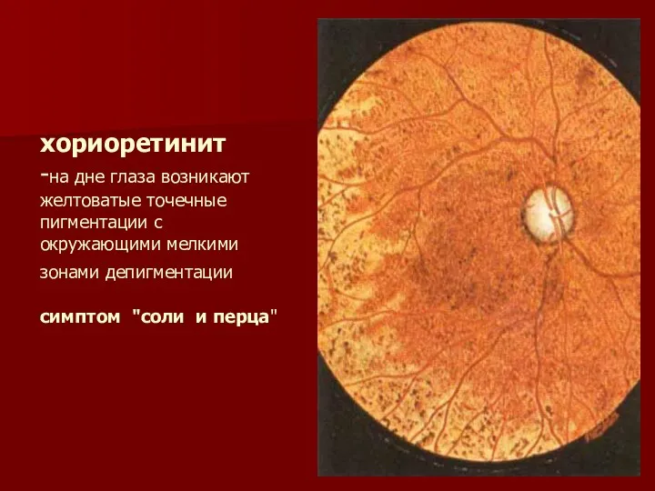 хориоретинит -на дне глаза возникают желтоватые точечные пигментации с окружающими