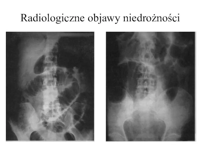 Radiologiczne objawy niedrożności