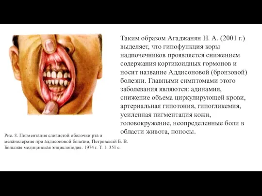 Рис. 8. Пигментация слизистой оболочки рта и меланодермия при аддисоновой