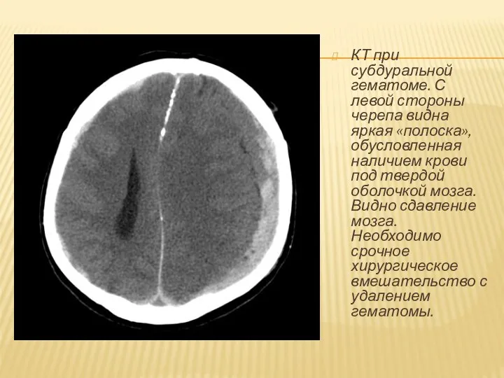 КТ при субдуральной гематоме. С левой стороны черепа видна яркая