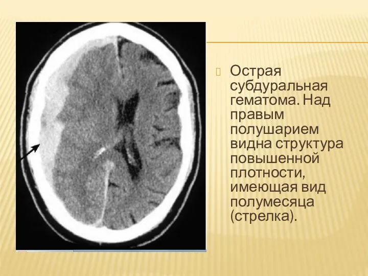 Острая субдуральная гематома. Над правым полушарием видна структура повышенной плотности, имеющая вид полумесяца (стрелка).