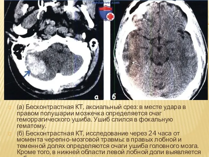 (а) Бесконтрастная КТ, аксиальный срез: в месте удара в правом