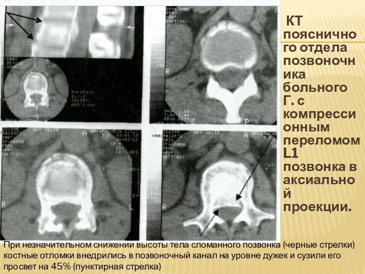 КТ поясничного отдела позвоночника больного Г. с компрессионным переломом L1