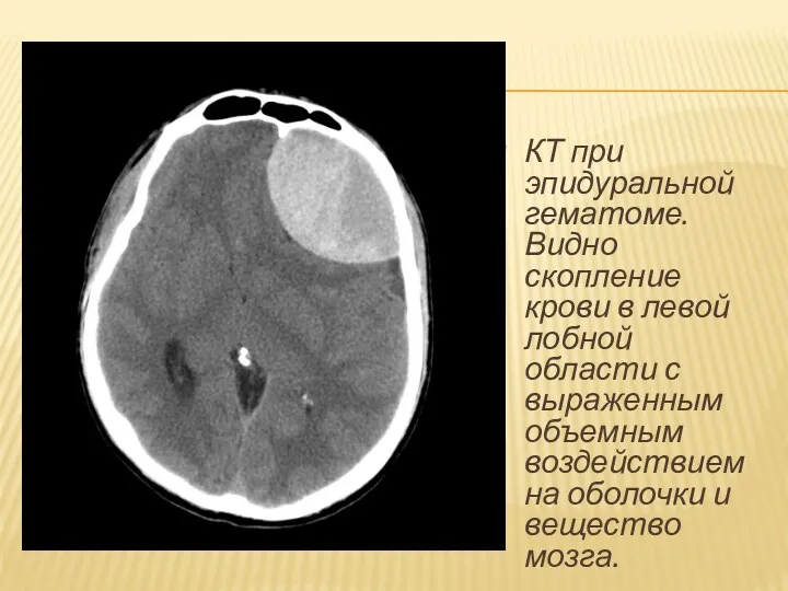 КТ при эпидуральной гематоме. Видно скопление крови в левой лобной