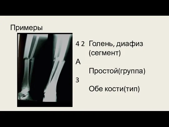 Примеры Голень, диафиз(сегмент) Простой(группа) Обе кости(тип) 4 2 А 3