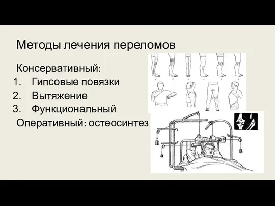 Методы лечения переломов Консервативный: Гипсовые повязки Вытяжение Функциональный Оперативный: остеосинтез