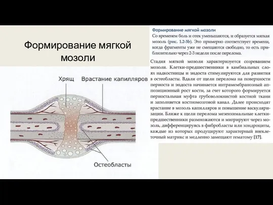 Формирование мягкой мозоли