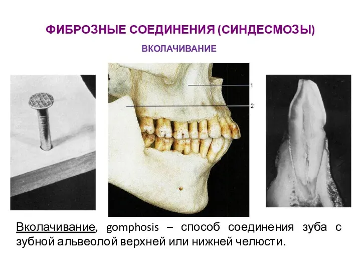 ФИБРОЗНЫЕ СОЕДИНЕНИЯ (СИНДЕСМОЗЫ) Вколачивание, gomphosis – способ соединения зуба с зубной альвеолой верхней