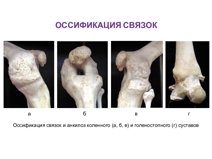 ОССИФИКАЦИЯ СВЯЗОК Оссификация связок и анкилоз коленного (а, б, в) и голеностопного (г)