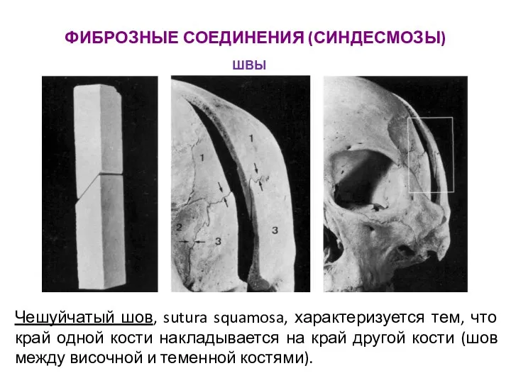 ФИБРОЗНЫЕ СОЕДИНЕНИЯ (СИНДЕСМОЗЫ) Чешуйчатый шов, sutura squamosa, характеризуется тем, что край одной кости