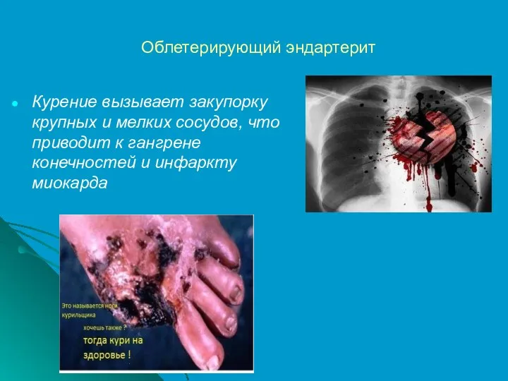 Облетерирующий эндартерит Курение вызывает закупорку крупных и мелких сосудов, что