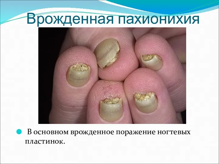 Врожденная пахионихия В основном врожденное поражение ногтевых пластинок.