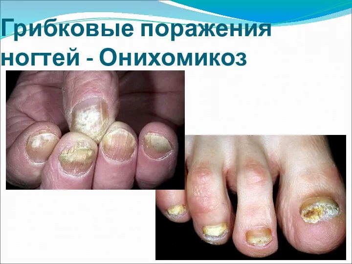 Грибковые поражения ногтей - Онихомикоз