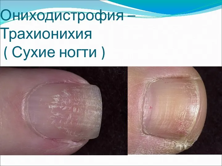 Ониходистрофия – Трахионихия ( Сухие ногти )