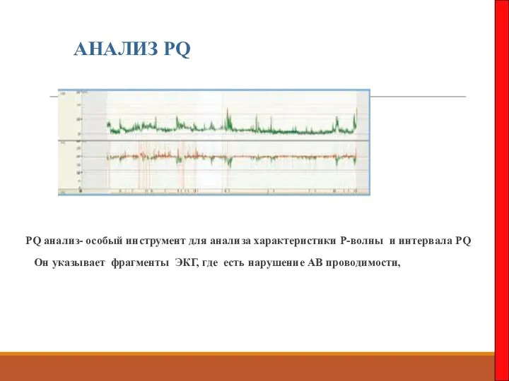 АНАЛИЗ PQ PQ анализ- особый инструмент для анализа характеристики Р-волны