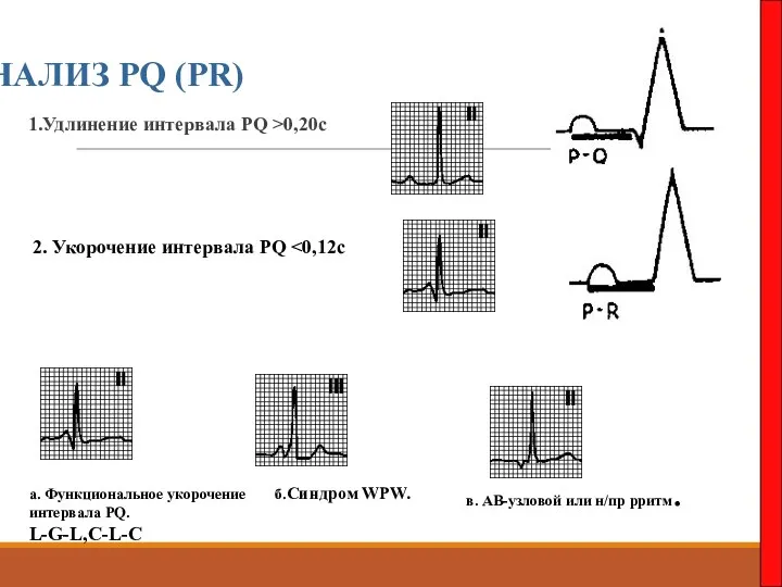 АНАЛИЗ PQ (PR) 1.Удлинение интервала PQ >0,20c 2. Укорочение интервала