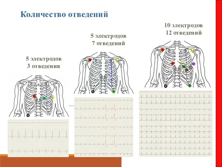 Количество отведений 5 электродов 3 отведения 5 электродов 7 отведений 10 электродов 12 отведений