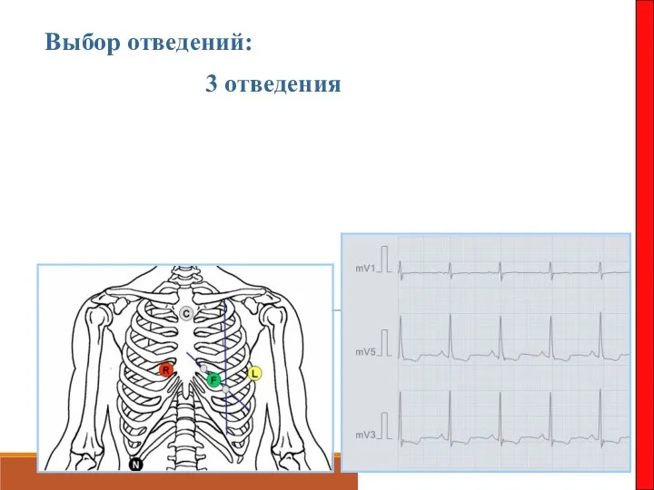 Выбор отведений: 3 отведения