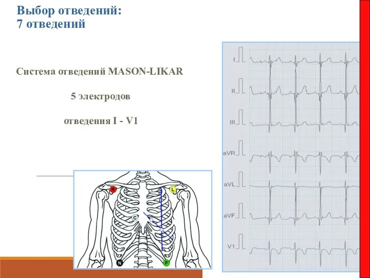 Выбор отведений: 7 отведений Система отведений MASON-LIKAR 5 электродов отведения I - V1