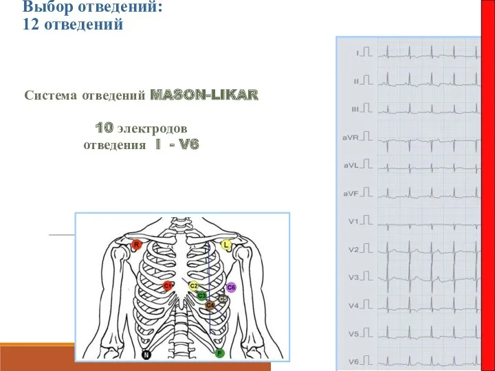 Выбор отведений: 12 отведений Система отведений MASON-LIKAR 10 электродов отведения I - V6