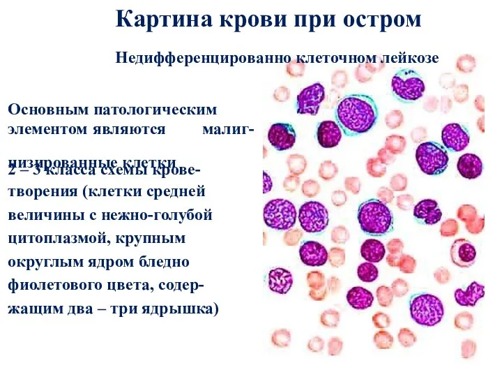 Картина крови при остром Недифференцированно клеточном лейкозе Основным патологическим элементом являются низированные клетки